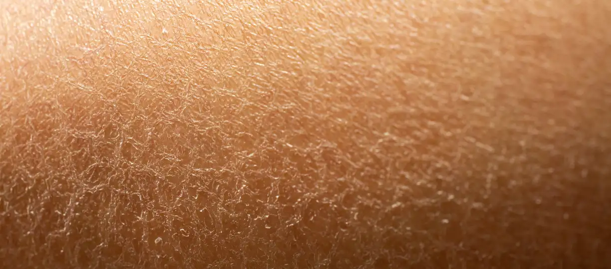 Trockene und dehydrierte Haut unterscheiden und richtig pflegen Trockene und dehydrierte Haut unterscheiden und richtig pflegen